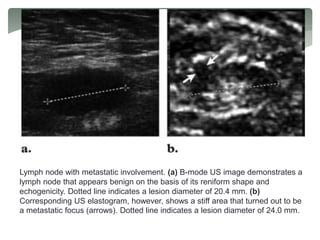 Lymph node with metastatic involvement. (a) B-mode US image demonstrates a
lymph node that appears benign on the basis of its reniform shape and
echogenicity. Dotted line indicates a lesion diameter of 20.4 mm. (b)
Corresponding US elastogram, however, shows a stiff area that turned out to be
a metastatic focus (arrows). Dotted line indicates a lesion diameter of 24.0 mm.
 