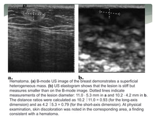 Hematoma. (a) B-mode US image of the breast demonstrates a superficial
heterogeneous mass. (b) US elastogram shows that the lesion is stiff but
measures smaller than on the B-mode image. Dotted lines indicate
measurements of the lesion diameter: 11.0  5.3 mm in a and 10.2  4.2 mm in b.
The distance ratios were calculated as 10.2  11.0 = 0.93 (for the long-axis
dimension) and as 4.2  5.3 = 0.79 (for the short-axis dimension). At physical
examination, skin discoloration was noted in the corresponding area, a finding
consistent with a hematoma.
 