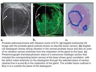 Prostate adenocarcinoma with Gleason score of 6/10. (a) Sagittal endorectal US
Image with the prostate gland outlined shows no discrete lesion (arrow). (b) Sagittal
US elastogram shows strong vibration in the normal prostate tissue and also an area
of no vibration (arrow) anteriorly from the midportion of the gland to the base. (c)
Photomicrograph (hematoxylineosin stain) of a transverse histologic section that
included the corresponding lesion (arrow) at the base shows good correlation, with
the deficit noted anteriorly on the elastogram through the selected plane of section
(dashed line in a and b) in the midportion of the gland. The smaller lesion outlined in
blue in c is outside the plane of the elastogram.
 