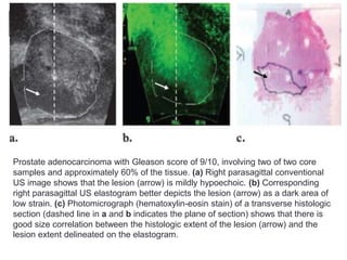 Prostate adenocarcinoma with Gleason score of 9/10, involving two of two core
samples and approximately 60% of the tissue. (a) Right parasagittal conventional
US image shows that the lesion (arrow) is mildly hypoechoic. (b) Corresponding
right parasagittal US elastogram better depicts the lesion (arrow) as a dark area of
low strain. (c) Photomicrograph (hematoxylin-eosin stain) of a transverse histologic
section (dashed line in a and b indicates the plane of section) shows that there is
good size correlation between the histologic extent of the lesion (arrow) and the
lesion extent delineated on the elastogram.
 