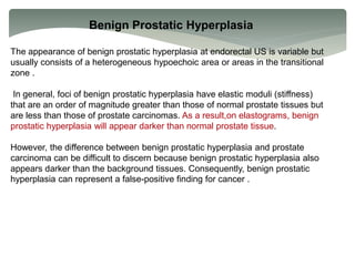 Benign Prostatic Hyperplasia
The appearance of benign prostatic hyperplasia at endorectal US is variable but
usually consists of a heterogeneous hypoechoic area or areas in the transitional
zone .
In general, foci of benign prostatic hyperplasia have elastic moduli (stiffness)
that are an order of magnitude greater than those of normal prostate tissues but
are less than those of prostate carcinomas. As a result,on elastograms, benign
prostatic hyperplasia will appear darker than normal prostate tissue.
However, the difference between benign prostatic hyperplasia and prostate
carcinoma can be difficult to discern because benign prostatic hyperplasia also
appears darker than the background tissues. Consequently, benign prostatic
hyperplasia can represent a false-positive finding for cancer .
 