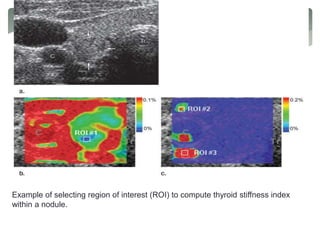 Example of selecting region of interest (ROI) to compute thyroid stiffness index
within a nodule.
 