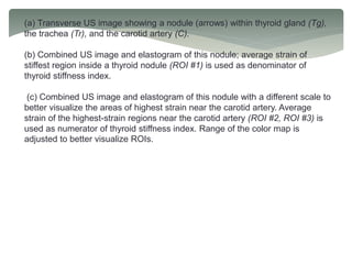 (a) Transverse US image showing a nodule (arrows) within thyroid gland (Tg),
the trachea (Tr), and the carotid artery (C).
(b) Combined US image and elastogram of this nodule; average strain of
stiffest region inside a thyroid nodule (ROI #1) is used as denominator of
thyroid stiffness index.
(c) Combined US image and elastogram of this nodule with a different scale to
better visualize the areas of highest strain near the carotid artery. Average
strain of the highest-strain regions near the carotid artery (ROI #2, ROI #3) is
used as numerator of thyroid stiffness index. Range of the color map is
adjusted to better visualize ROIs.
 