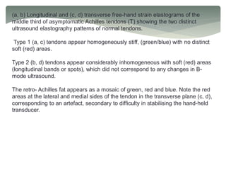 (a, b) Longitudinal and (c, d) transverse free-hand strain elastograms of the
middle third of asymptomatic Achilles tendons (T) showing the two distinct
ultrasound elastography patterns of normal tendons.
Type 1 (a, c) tendons appear homogeneously stiff, (green/blue) with no distinct
soft (red) areas.
Type 2 (b, d) tendons appear considerably inhomogeneous with soft (red) areas
(longitudinal bands or spots), which did not correspond to any changes in B-
mode ultrasound.
The retro- Achilles fat appears as a mosaic of green, red and blue. Note the red
areas at the lateral and medial sides of the tendon in the transverse plane (c, d),
corresponding to an artefact, secondary to difficulty in stabilising the hand-held
transducer.
 
