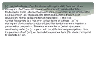 (a) Longitudinal colour Doppler ultrasound image and (b) free-hand strain
elastogram of a 23-year-old recreational runner with insertional Achilles
tendinopathy. There is hypoechogenicity and neovascularity at the tendinopathic
area [asterisk in (a)], which appears softer (red) compared with the stiff
(blue/green) normal-appearing remaining tendon (T). The retro-
Achilles fat appears as a mosaic of various levels of stiffness. (c) The
elastogram of a normal (asymptomatic) Achilles tendon calcaneal insertion is
presented for comparison. The retrocalcaneal bursa (asterisk) appears
considerably softer (red) compared with the stiffer tendon (green/yellow). Note
the presence of soft (red) foci beneath the calcaneal bone (C), which correspond
to artefacts. LT, left.
 