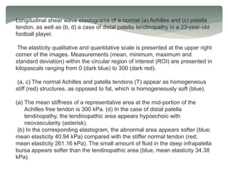 Longitudinal shear wave elastograms of a normal (a) Achilles and (c) patella
tendon, as well as (b, d) a case of distal patella tendinopathy in a 23-year-old
football player.
The elasticity qualitative and quantitative scale is presented at the upper right
corner of the images. Measurements (mean, minimum, maximum and
standard deviation) within the circular region of interest (ROI) are presented in
kilopascals ranging from 0 (dark blue) to 300 (dark red).
(a, c) The normal Achilles and patella tendons (T) appear as homogeneous
stiff (red) structures, as opposed to fat, which is homogeneously soft (blue).
(a) The mean stiffness of a representative area at the mid-portion of the
Achilles free tendon is 300 kPa. (d) In the case of distal patella
tendinopathy, the tendinopathic area appears hypoechoic with
neovascularity (asterisk).
(b) In the corresponding elastogram, the abnormal area appears softer (blue;
mean elasticity 40.94 kPa) compared with the stiffer normal tendon (red;
mean elasticity 261.16 kPa). The small amount of fluid in the deep infrapatella
bursa appears softer than the tendinopathic area (blue, mean elasticity 34.38
kPa).
 