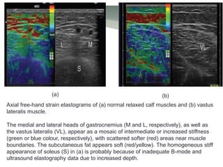 (a) (b)
Axial free-hand strain elastograms of (a) normal relaxed calf muscles and (b) vastus
lateralis muscle.
The medial and lateral heads of gastrocnemius (M and L, respectively), as well as
the vastus lateralis (VL), appear as a mosaic of intermediate or increased stiffness
(green or blue colour, respectively), with scattered softer (red) areas near muscle
boundaries. The subcutaneous fat appears soft (red/yellow). The homogeneous stiff
appearance of soleus (S) in (a) is probably because of inadequate B-mode and
ultrasound elastography data due to increased depth.
 