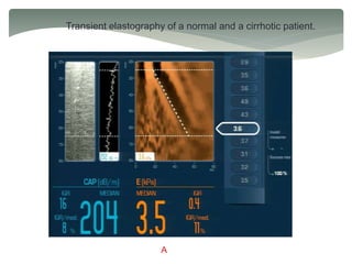 Transient elastography of a normal and a cirrhotic patient.
A
 