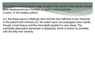 The displacement M-mode image located in the center of the monitor shows
axial displacement as a function of depth (y-axis) and time
(x-axis). In the healthy patient
(A), the shear wave is relatively slow and the liver stiffness is low. However,
in the patient with cirrhosis (B), the shear wave can propagate more rapidly
though a hard tissue, and the time-depth gradient is very steep. The
controlled attenuation parameter is displayed, which is known to correlate
with the fatty liver severity
 