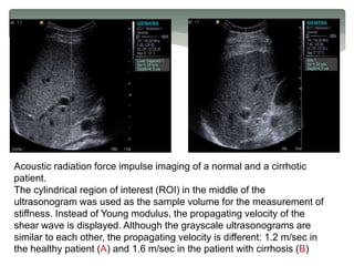 Acoustic radiation force impulse imaging of a normal and a cirrhotic
patient.
The cylindrical region of interest (ROI) in the middle of the
ultrasonogram was used as the sample volume for the measurement of
stiffness. Instead of Young modulus, the propagating velocity of the
shear wave is displayed. Although the grayscale ultrasonograms are
similar to each other, the propagating velocity is different: 1.2 m/sec in
the healthy patient (A) and 1.6 m/sec in the patient with cirrhosis (B)
 