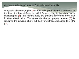 Acute exacerbation of hepatitis B virus-induced hepatitis.
Grayscale ultrasonography (A) shows mild parenchymal coarseness of
the liver; the liver stiffness is 10.3 kPa according to the shear wave
elastography (B). Six months later, the patients recovered from liver
function deterioration. The grayscale ultrasonographic feature (C) is
similar to the previous study, but the liver stiffness decreases to 6 kPa
(D).
 