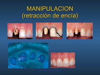MANIPULACION (retracción de encía) 