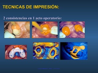 TECNICAS DE IMPRESIÓN: 2 consistencias en 1 acto operatorio: 