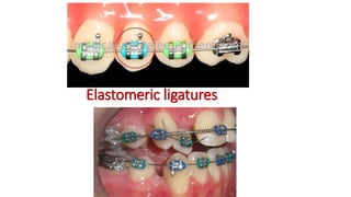 Elastomeric ligatures
 