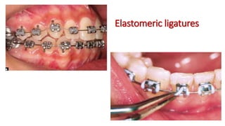 Elastomeric ligatures
 