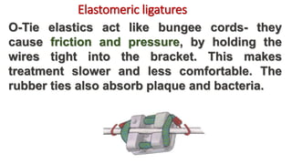 O-Tie elastics act like bungee cords- they
cause friction and pressure, by holding the
wires tight into the bracket. This makes
treatment slower and less comfortable. The
rubber ties also absorb plaque and bacteria.
Elastomeric ligatures
 