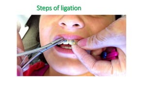 Steps of ligation
 