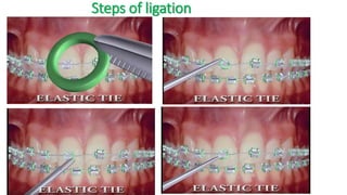 Steps of ligation
 