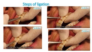 Steps of ligation
 