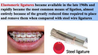 Elastomeric ligatures became available in the late 1960s and
rapidly became the most common means of ligation, almost
entirely because of the greatly reduced time required to place
and remove them when compared with steel wire ligatures
Steel ligature
 