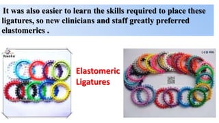 It was also easier to learn the skills required to place these
ligatures, so new clinicians and staff greatly preferred
elastomerics .
Elastomeric
Ligatures
 