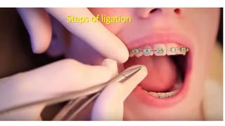 Steps of ligation
 