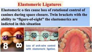 Elastomeric o ties cause loss of rotational control of
canines during space closure. Twin brackets with the
ability to “figure-of-eight” the elastomerics are
indicted in this situation
Loss of arch wire control
with elastomeric ligation.
Elastomeric Ligatures
 