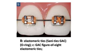 B: elastomeric ties (Sani-ties GAC)
(O-ring); c: GAC figure-of-eight
elastomeric ties;
 