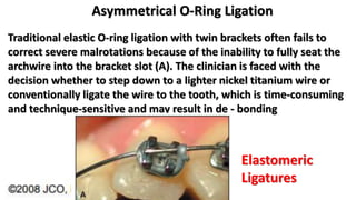 Asymmetrical O-Ring Ligation
Traditional elastic O-ring ligation with twin brackets often fails to
correct severe malrotations because of the inability to fully seat the
archwire into the bracket slot (A). The clinician is faced with the
decision whether to step down to a lighter nickel titanium wire or
conventionally ligate the wire to the tooth, which is time-consuming
and technique-sensitive and may result in de - bonding
Elastomeric
Ligatures
 