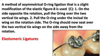 A method of asymmetrical O-ring ligation that is a slight
modification of the elastic figure-8 is used (C): 1. On the
side opposite the rotation, pull the Oring over the two
vertical tie wings. 2. Pull the O-ring under the incisal tie
wing on the rotation side. The O-ring should now seat over
the two vertical tie wings on the side away from the
rotation.
Elastomeric Ligatures
 