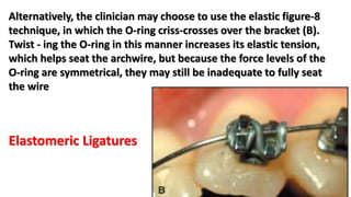 Alternatively, the clinician may choose to use the elastic figure-8
technique, in which the O-ring criss-crosses over the bracket (B).
Twist - ing the O-ring in this manner increases its elastic tension,
which helps seat the archwire, but because the force levels of the
O-ring are symmetrical, they may still be inadequate to fully seat
the wire
Elastomeric Ligatures
 