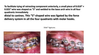 Retraction with elastomeric chain. Retraction with elastic module.
To facilitate tying of retracting component anteriorly, a small piece of 0.019″ ×
0.025″ wire was shaped as “S” and welded to the base arch wire in all four
quadrants immediately
distal to canines. This “S”-shaped wire was ligated by the force
delivery system in all the four quadrants with molar hooks.
Slide* ligatures
 