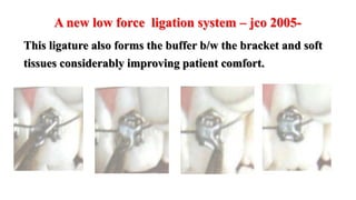 This ligature also forms the buffer b/w the bracket and soft
tissues considerably improving patient comfort.
A new low force ligation system – jco 2005-
 