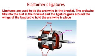Ligatures are used to tie the archwire to the bracket. The archwire
fits into the slot in the bracket and the ligature goes around the
wings of the bracket to hold the archwire in place
Elastomeric ligatures
 