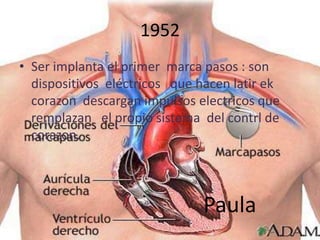 1952
• Ser implanta el primer marca pasos : son
  dispositivos eléctricos que hacen latir ek
  corazon descargan impulsos electricos que
  remplazan el propio sistema del contrl de
  corazon.




                               Paula
 