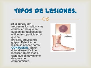 
Tipos de lesiones.
En la danza, son
frecuentes los saltos y las
caídas, en las que se
pueden dar raspones por
el tipo de superficie en el
que se
practica, provocando
golpes. Este tipo de
lesión se conoce como
CONTUSIÓN. Es un
dolor difuso difícil de
localizar. Duele más al
tacto que al movimiento
después del
entrenamiento.
 