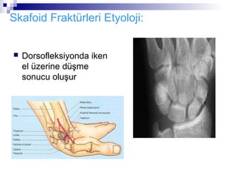 Skafoid Fraktürleri Etyoloji:


   Dorsofleksiyonda iken
    el üzerine düşme
    sonucu oluşur
 