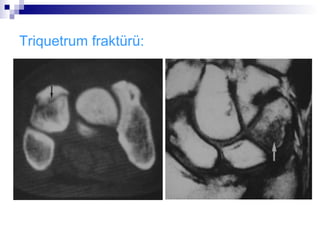 Triquetrum fraktürü:
 