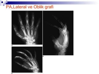 PA,Lateral ve Oblik grafi
 
