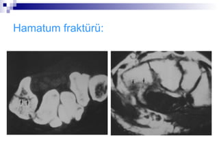 Hamatum fraktürü:
 