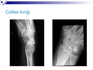 Colles kırığı
 