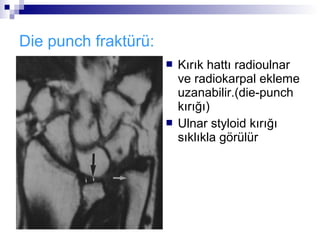Die punch fraktürü:
                         Kırık hattı radioulnar
                          ve radiokarpal ekleme
                          uzanabilir.(die-punch
                          kırığı)
                         Ulnar styloid kırığı
                          sıklıkla görülür
 