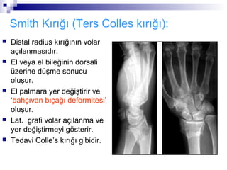 Smith Kırığı (Ters Colles kırığı):
   Distal radius kırığının volar
    açılanmasıdır.
   El veya el bileğinin dorsali
    üzerine düşme sonucu
    oluşur.
   El palmara yer değiştirir ve
    ‘bahçıvan bıçağı deformitesi’
    oluşur.
   Lat. grafi volar açılanma ve
    yer değiştirmeyi gösterir.
   Tedavi Colle’s kırığı gibidir.
 