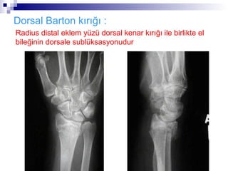 Dorsal Barton kırığı :
Radius distal eklem yüzü dorsal kenar kırığı ile birlikte el
bileğinin dorsale sublüksasyonudur
 