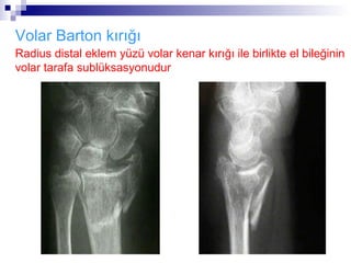 Volar Barton kırığı
Radius distal eklem yüzü volar kenar kırığı ile birlikte el bileğinin
volar tarafa sublüksasyonudur
 