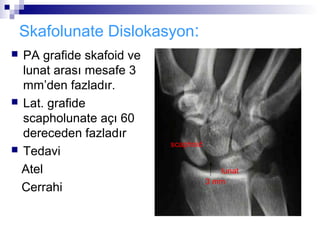 Skafolunate Dislokasyon:
 PA grafide skafoid ve
  lunat arası mesafe 3
  mm’den fazladır.
 Lat. grafide
  scapholunate açı 60
  dereceden fazladır
                          scaphoid
 Tedavi

  Atel                                  lunat
                                     3 mm
  Cerrahi
 