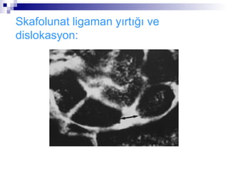 Skafolunat ligaman yırtığı ve
dislokasyon:
 
