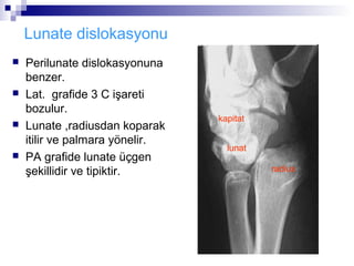 Lunate dislokasyonu
   Perilunate dislokasyonuna
    benzer.
   Lat. grafide 3 C işareti
    bozulur.
                                 kapitat
   Lunate ,radiusdan koparak
    itilir ve palmara yönelir.
                                   lunat
   PA grafide lunate üçgen
    şekillidir ve tipiktir.                radius
 