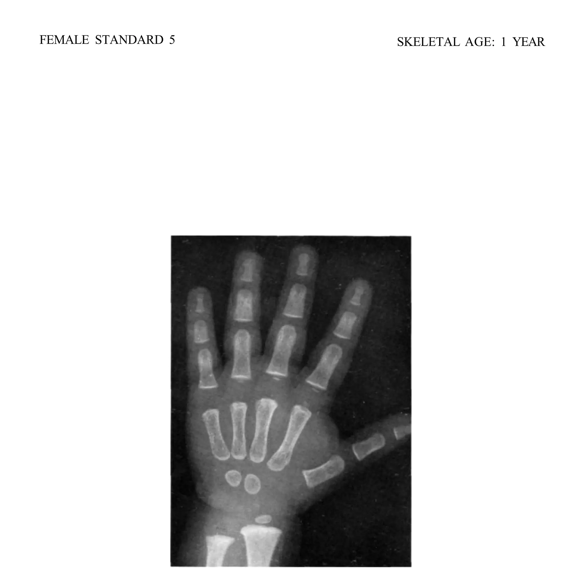 bone age atlas bone age atlas bone age atlas | PDF