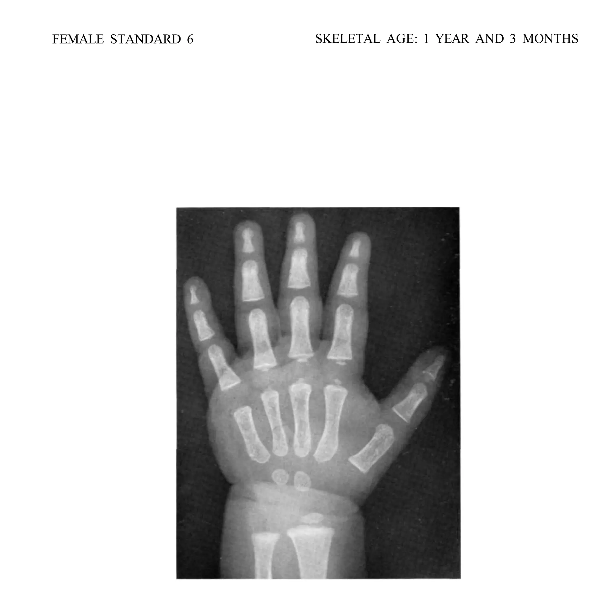 bone age atlas bone age atlas bone age atlas | PDF